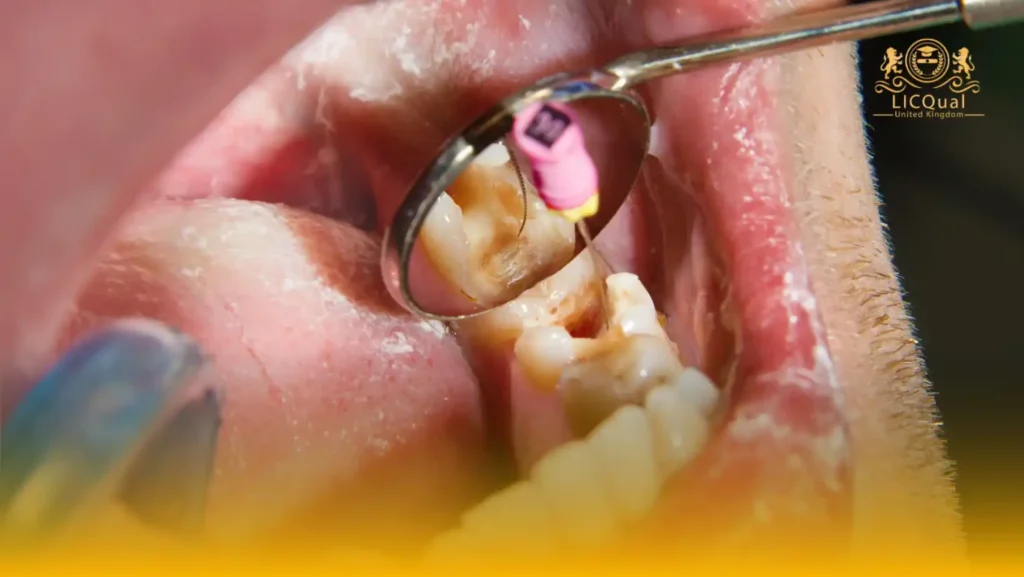 LICQual Level 3 Certificate in Endodontics 5 LICQual Level 3 Certificate in Endodontics