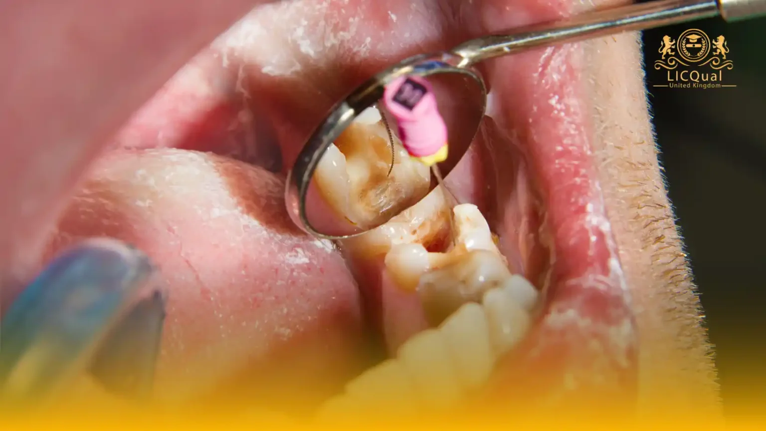 LICQual Level 3 Certificate in Endodontics