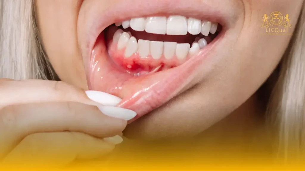 LICQual Level 3 Certificate in Periodontics 16 LICQual Level 3 Certificate in Periodontics