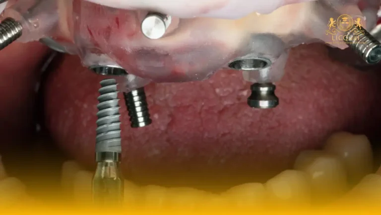 LICQual Level 6 Diploma in Implant Dentistry (Dip Implant Dentistry) 